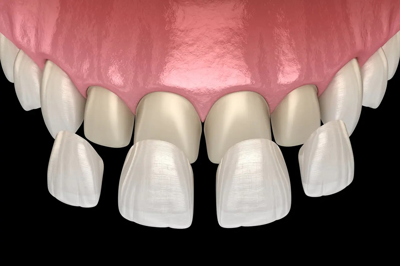 ラミネートベニアクラウン