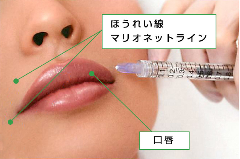 ヒアルロン酸注入治療