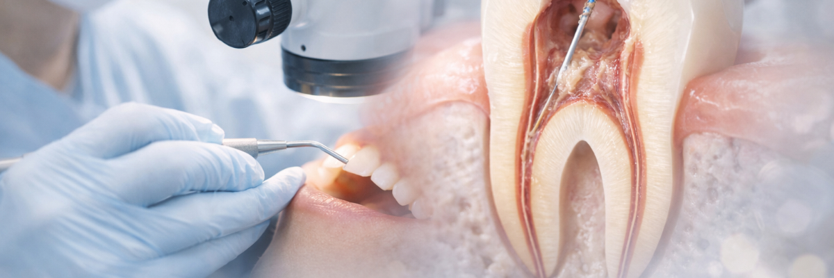 精密根管治療（マイクロエンド）