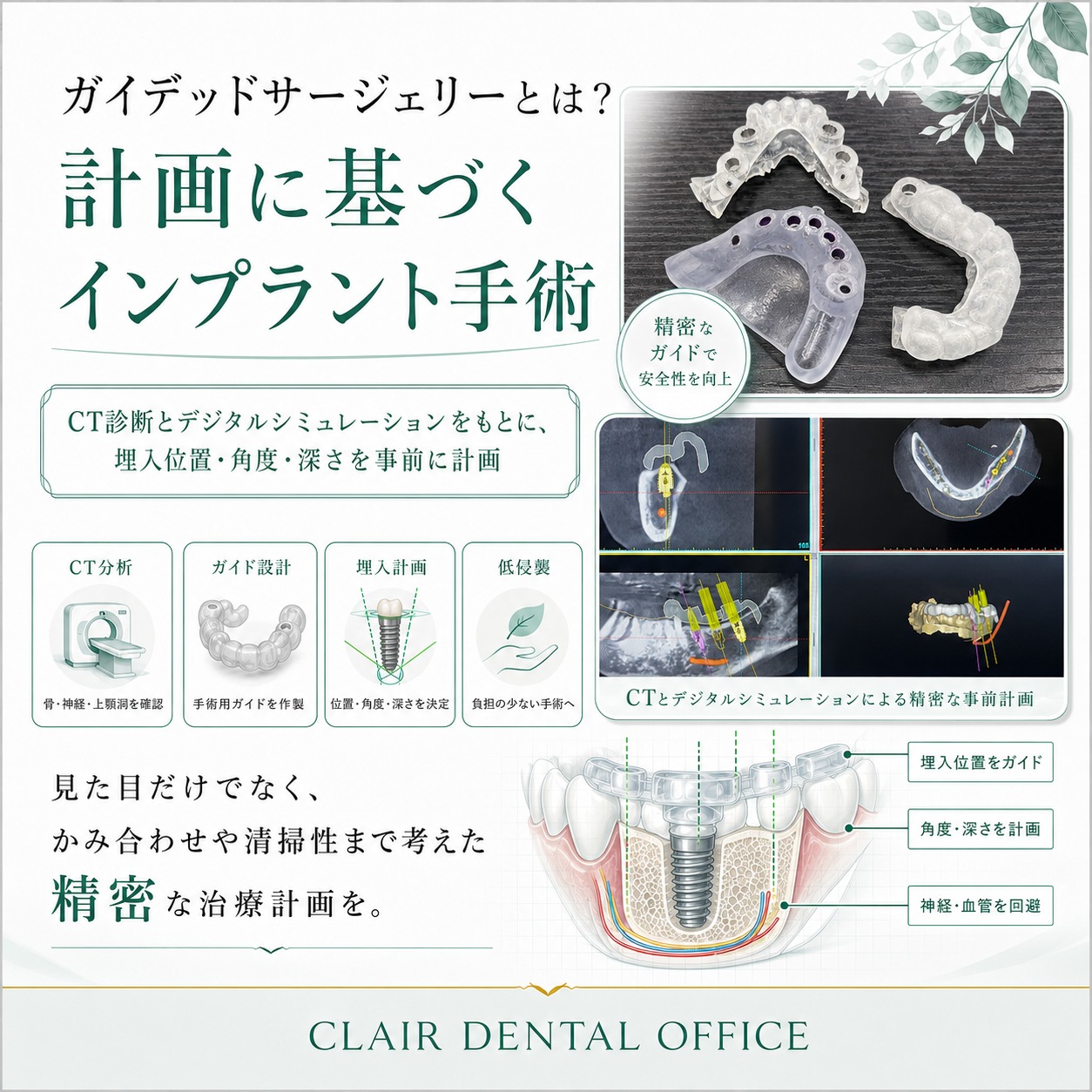 ガイデッドサージェリーとは？計画に基づくインプラント手術